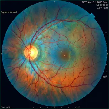 Retina & Vitreous